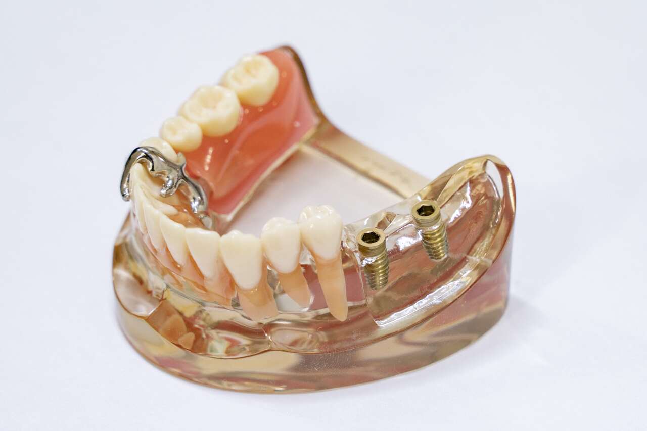 インプラント（歯の欠損部に人工歯根を植えご自分の歯のようにかめるようになる治療です）